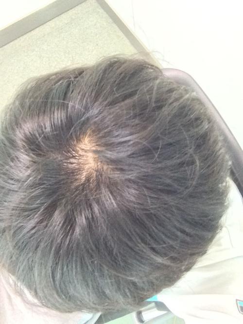 发旋