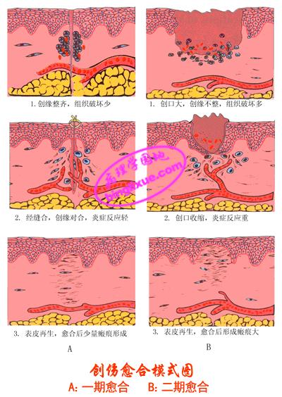 二期愈合