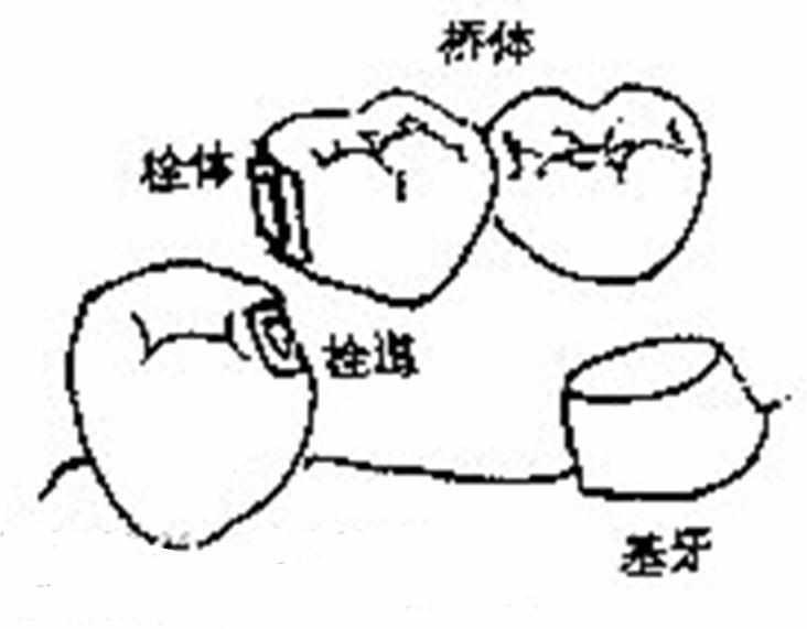 半固定桥